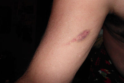 Unexplained bite marks